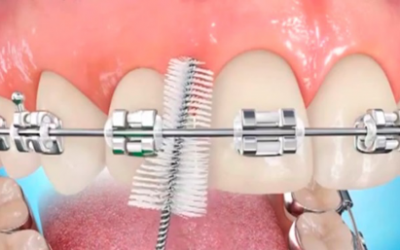 Limpieza de la ortodoncia
