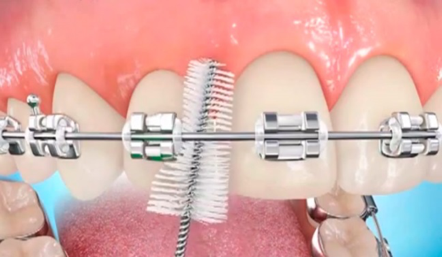 Limpieza de la ortodoncia