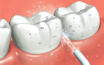Cómo usar un irrigador dental o bucal